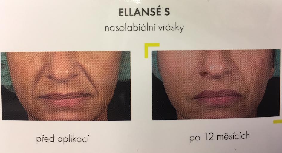 Ellanse S (2 x 1ml) - tekuté nitě
